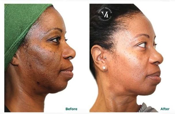 Before and after skin treatment showing improved skin clarity and texture.